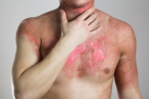 Torso of man with severe burn injuries